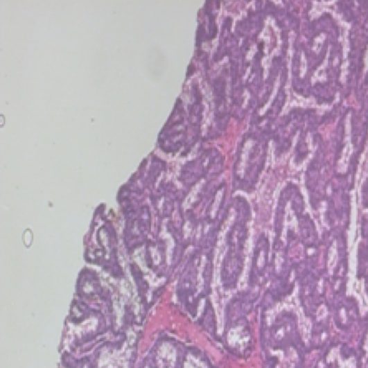 Breast tissue slide, true label malignant
